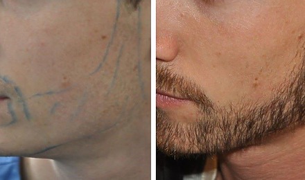 Beard Transplant Timeline: Recovery, Risks And Results