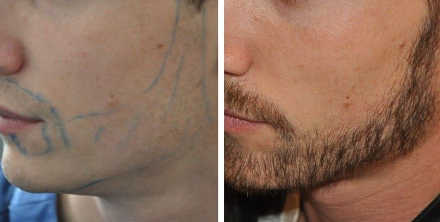 Beard Transplant Timeline: Recovery, Risks And Results