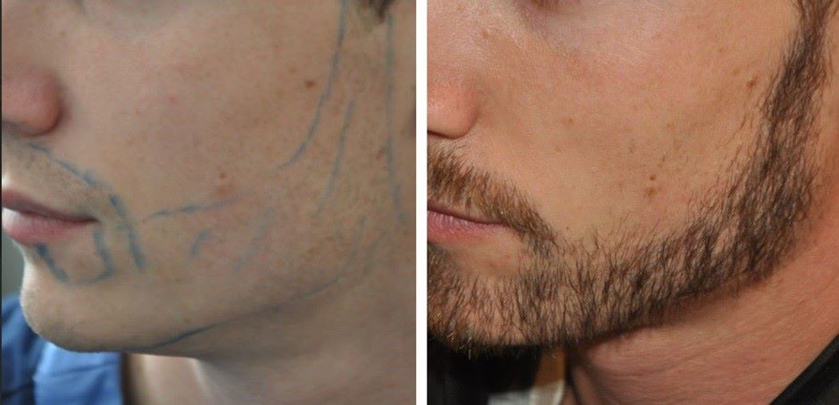 Beard Transplant Timeline: Recovery, Risks and Results