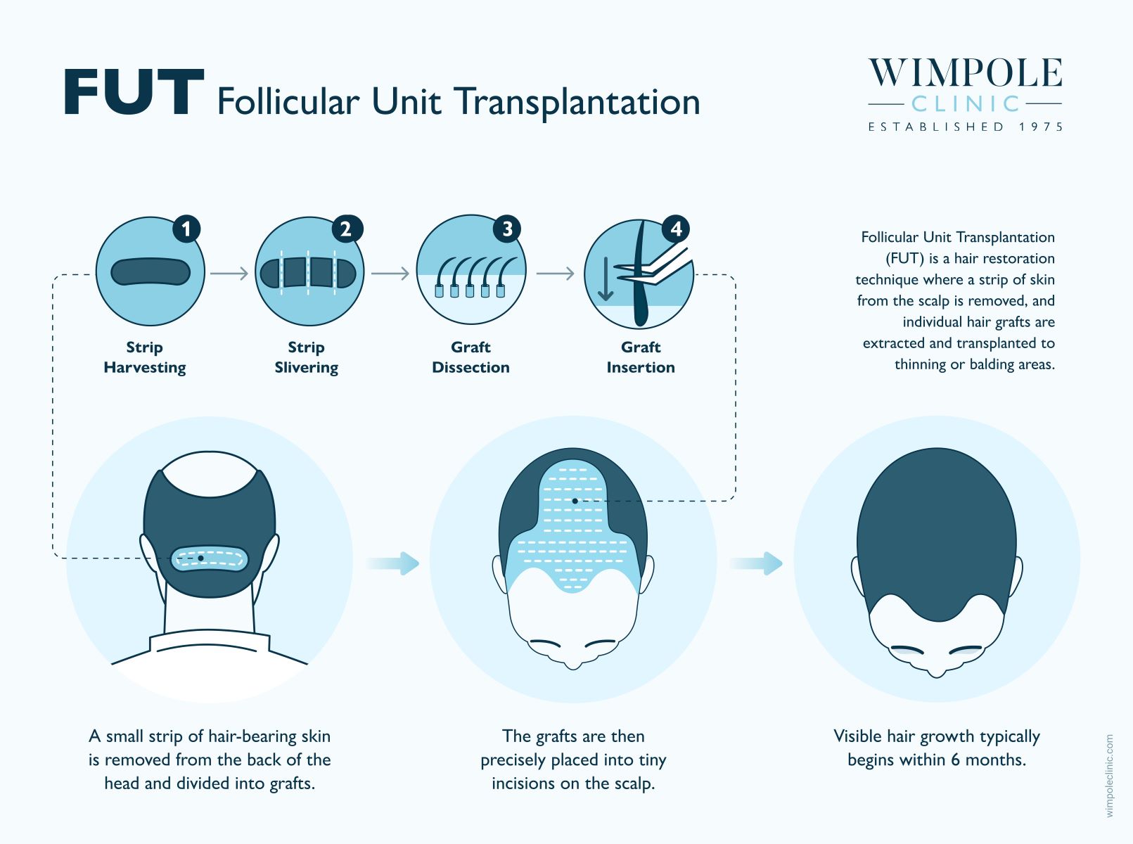 FUT Follicular Unit Transplantation