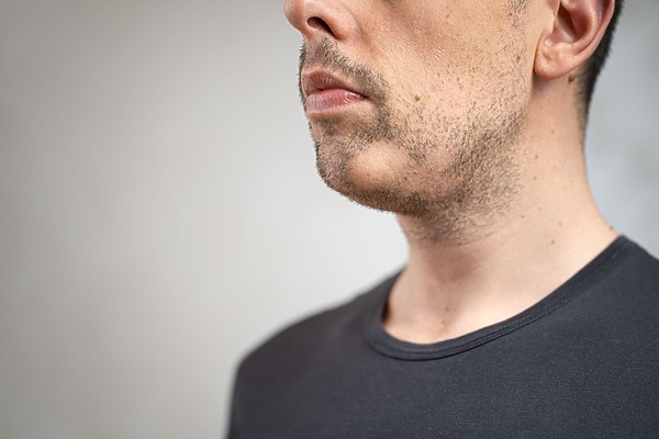 Fixing Beard Bald Spots From Alopecia Barbae & Other Causes