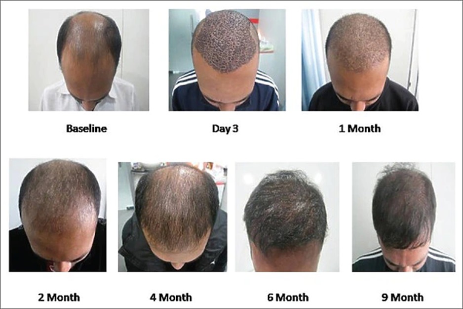 Hair growth in man who had PRP alongside hair transplant