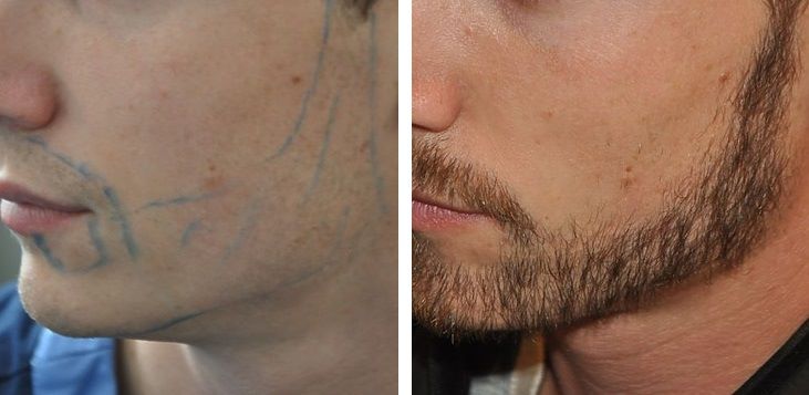 Man before and after 2600 graft beard transplant