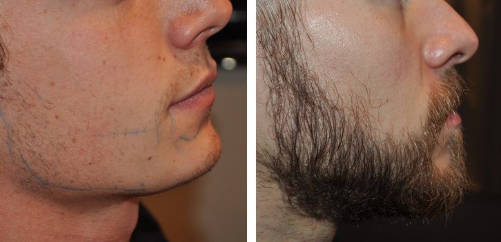 Man before and after 3400 graft beard transplant