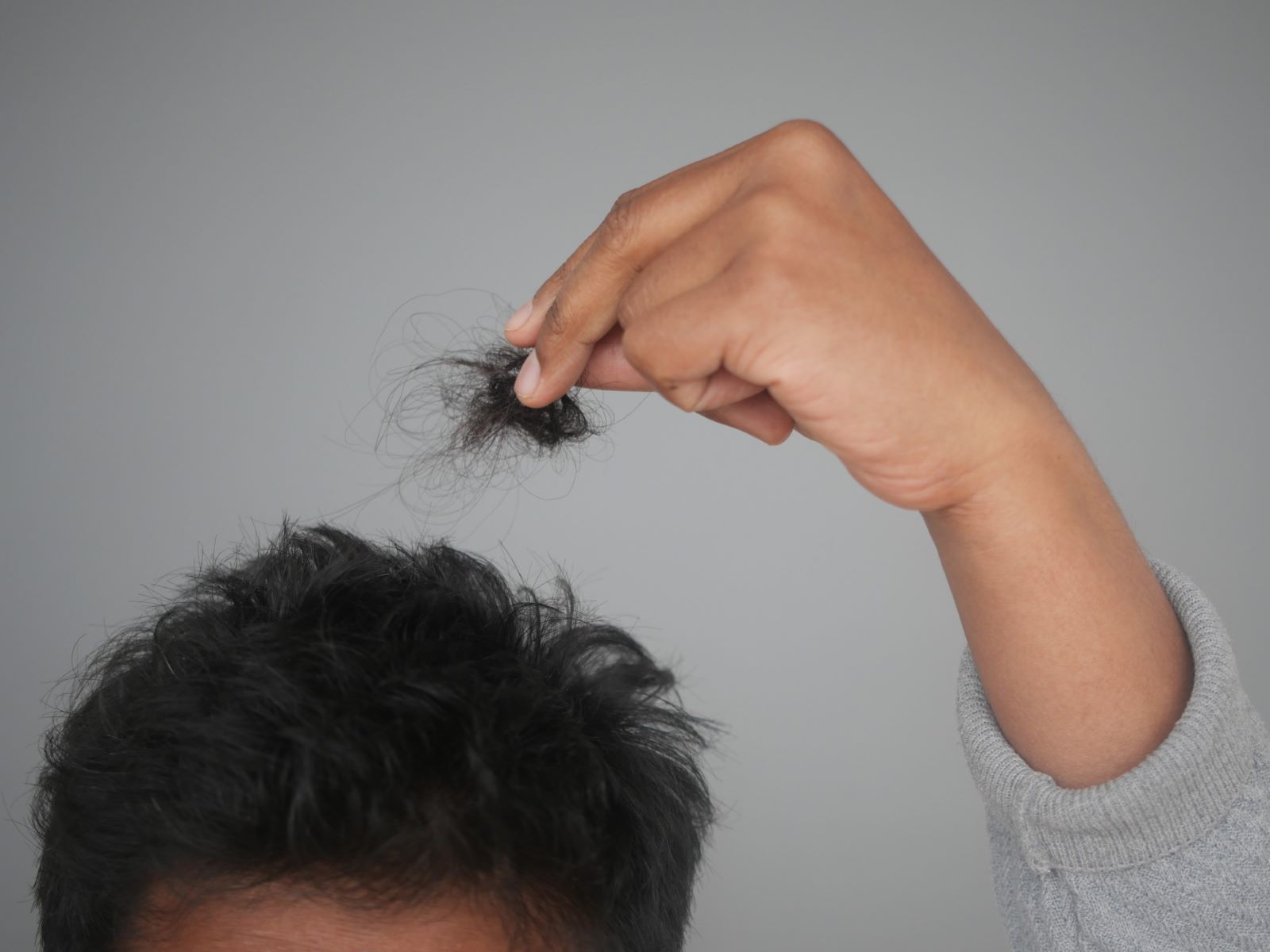 Man experiencing Minoxidil hair shedding