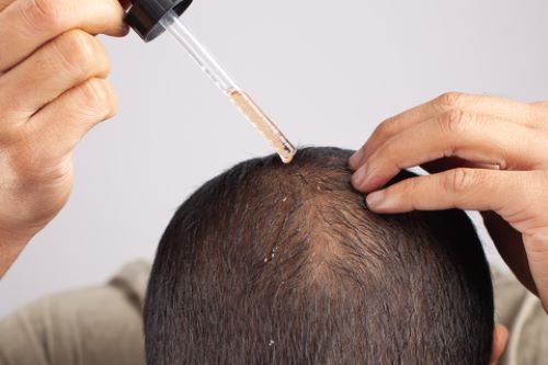 Man with male pattern baldness applying pumpkin seed oil to thinning hair