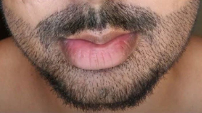 Patient 10 days after his beard transplant