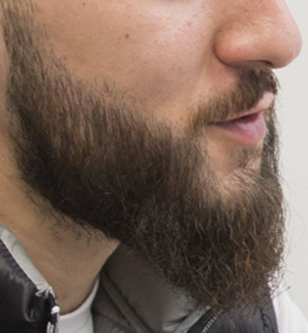 Patient 10 months after his beard transplant