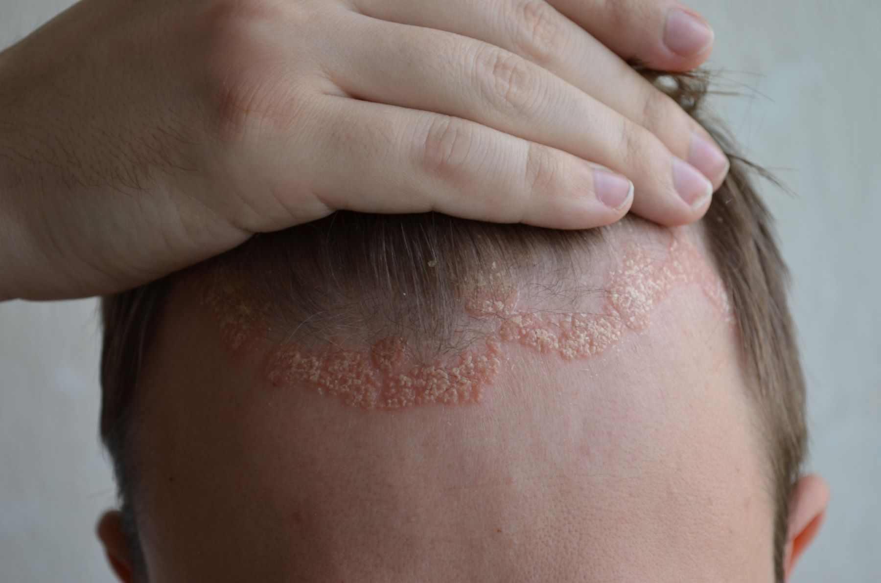 Patient with scalp psoriasis