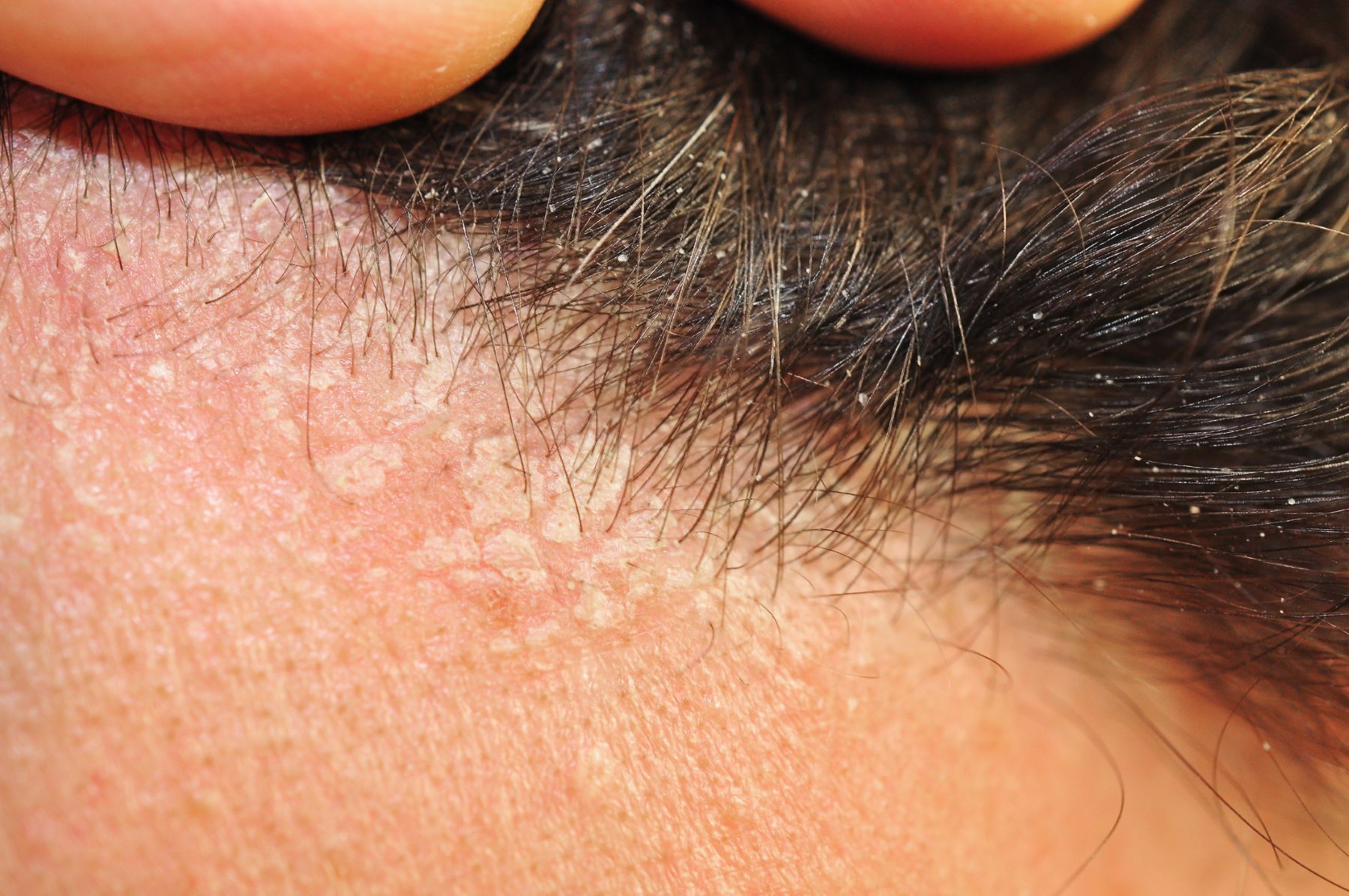 Seborrheic dermatitis of the scalp