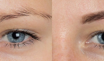 Sparse Eyebrows Before And After Eyebrow Treatments