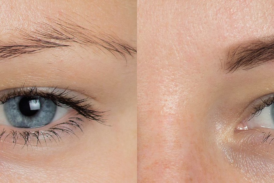 Sparse Eyebrows Before And After Eyebrow Treatments