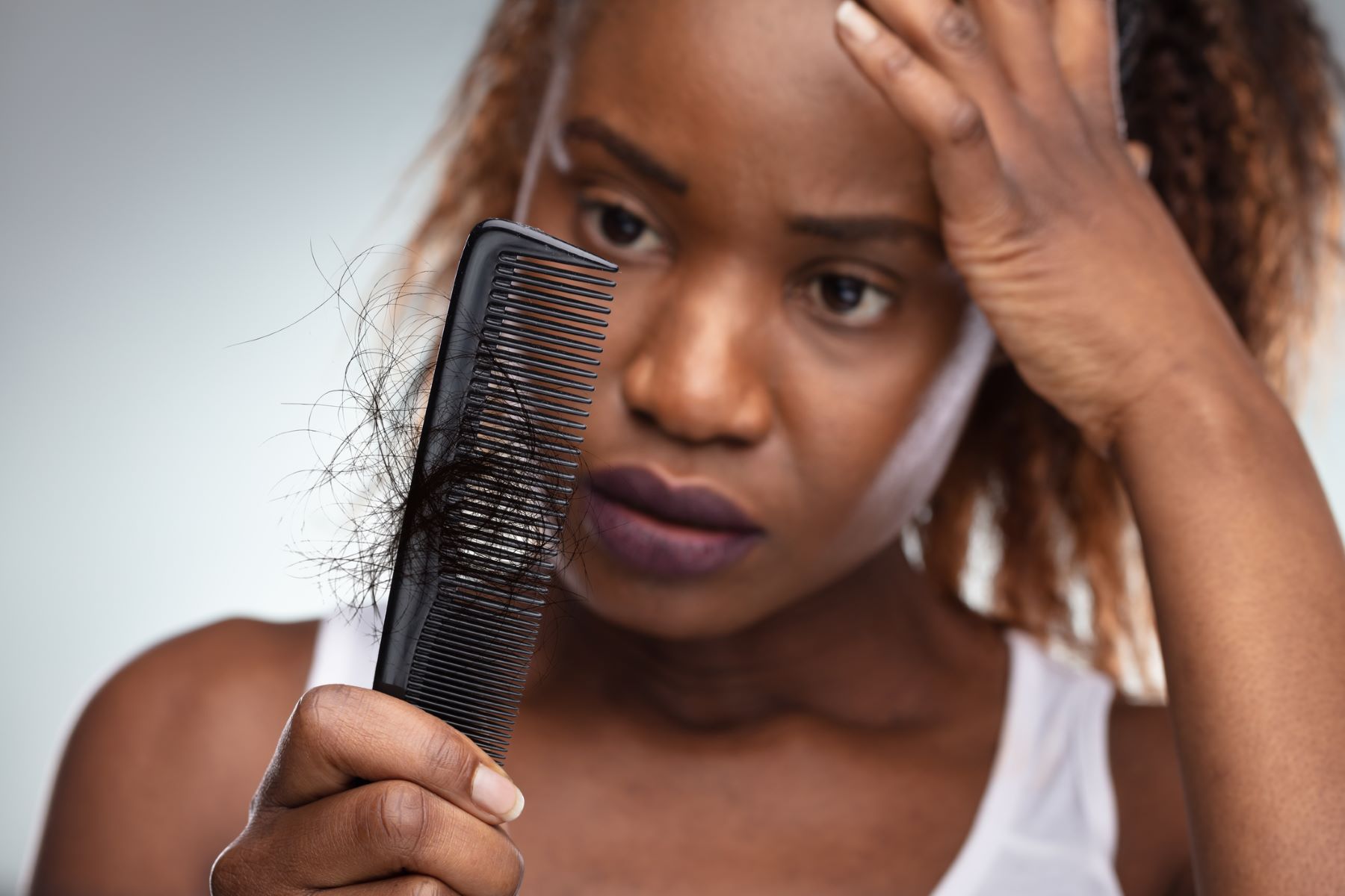 Woman who developed Minoxidil hair shedding