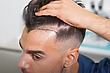 Hair Transplant