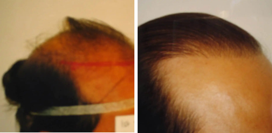 4000 grafts before and after FUT and FUE hair transplants