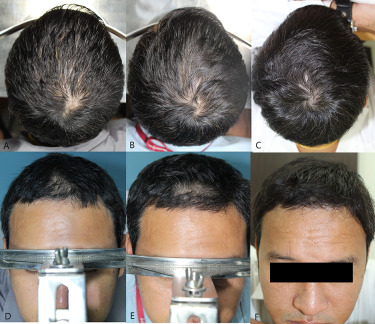 5mg of oral Minoxidil for 3 months