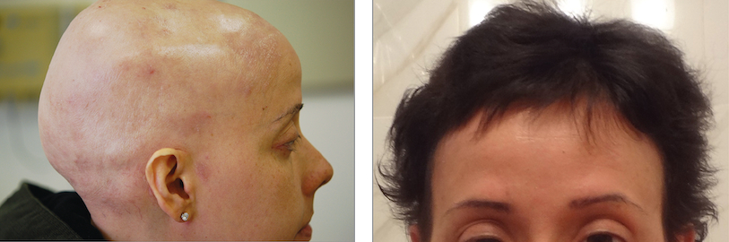 A patient with AU before and after Adalimumab treatment