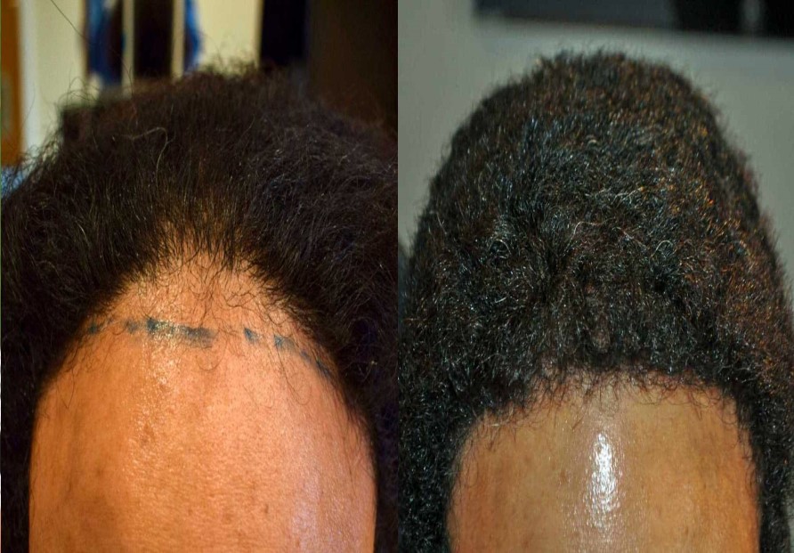 before and after 500 grafts afro hair transplant