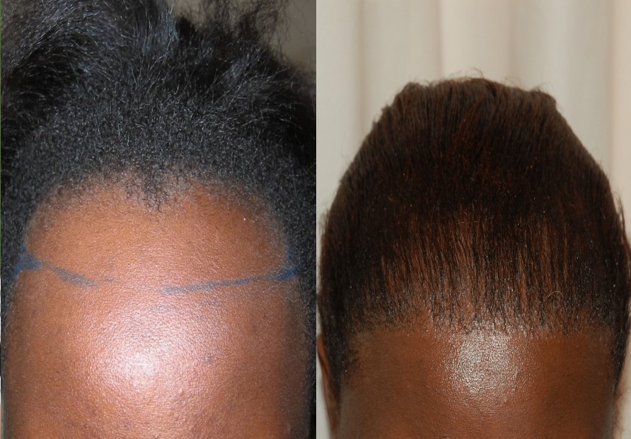 hairline before and after afro hair transplant