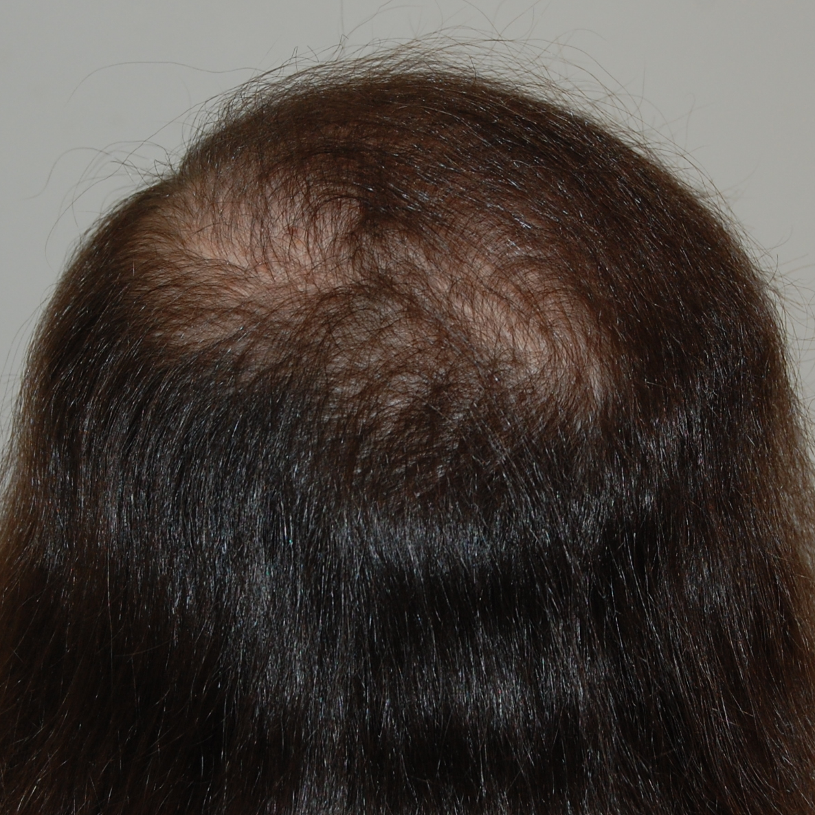 FUT Hair Transplant, Wimpole Clinic