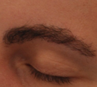 Eyebrow Transplant, Wimpole Clinic