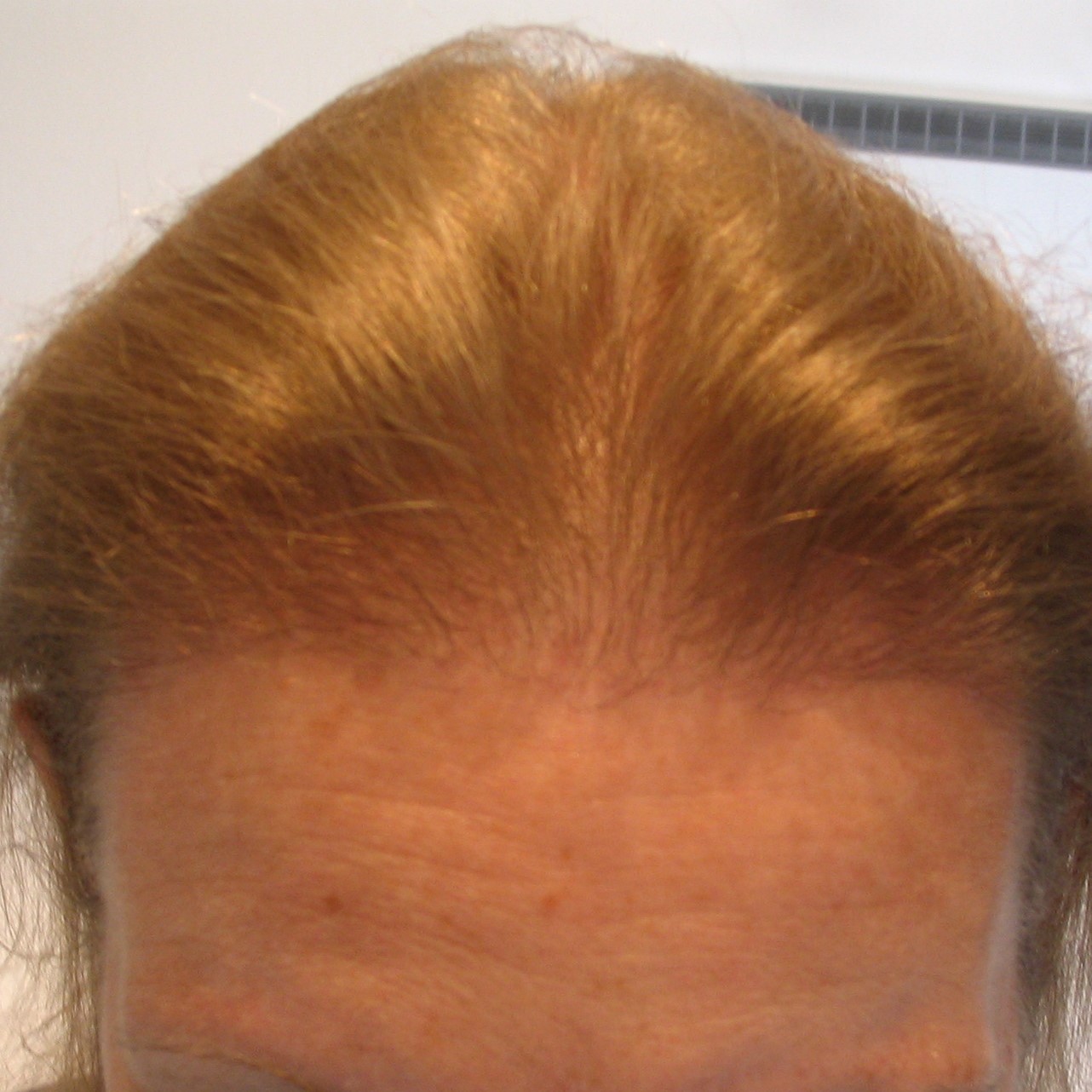 Female Hair Transplant, Wimpole Clinic