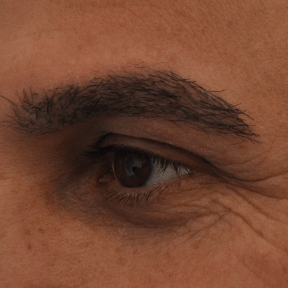 Eyebrow Transplant, Wimpole Clinic