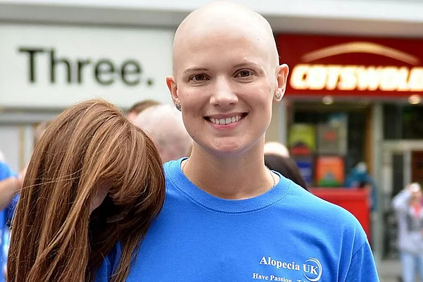 Can You Get Alopecia Areata Treatment On The NHS?