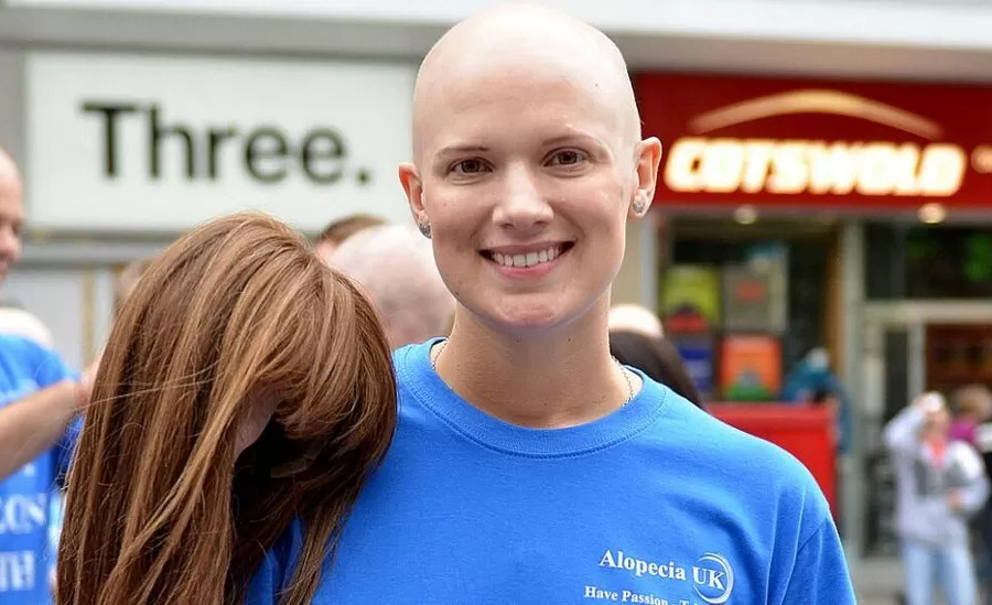 Can You Get Alopecia Areata Treatment On The NHS?