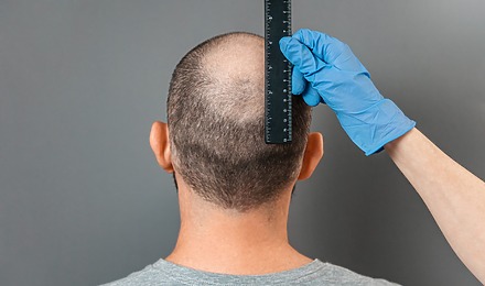 Balding Crown Featured Image