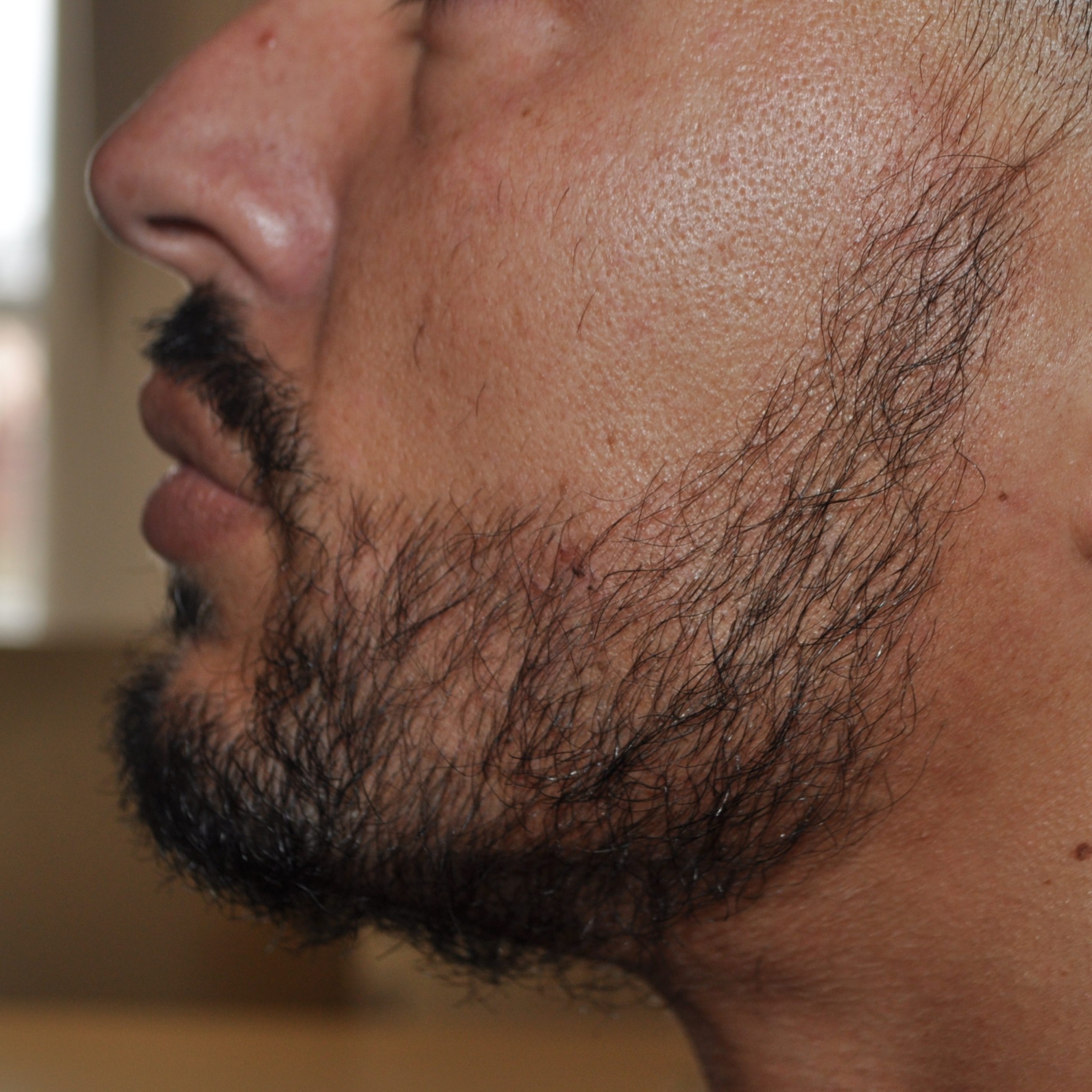 Beard Transplant, Wimpole Clinic