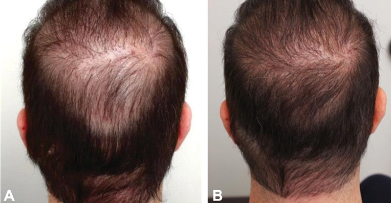 Beard hair used to perform crown hair transplant.