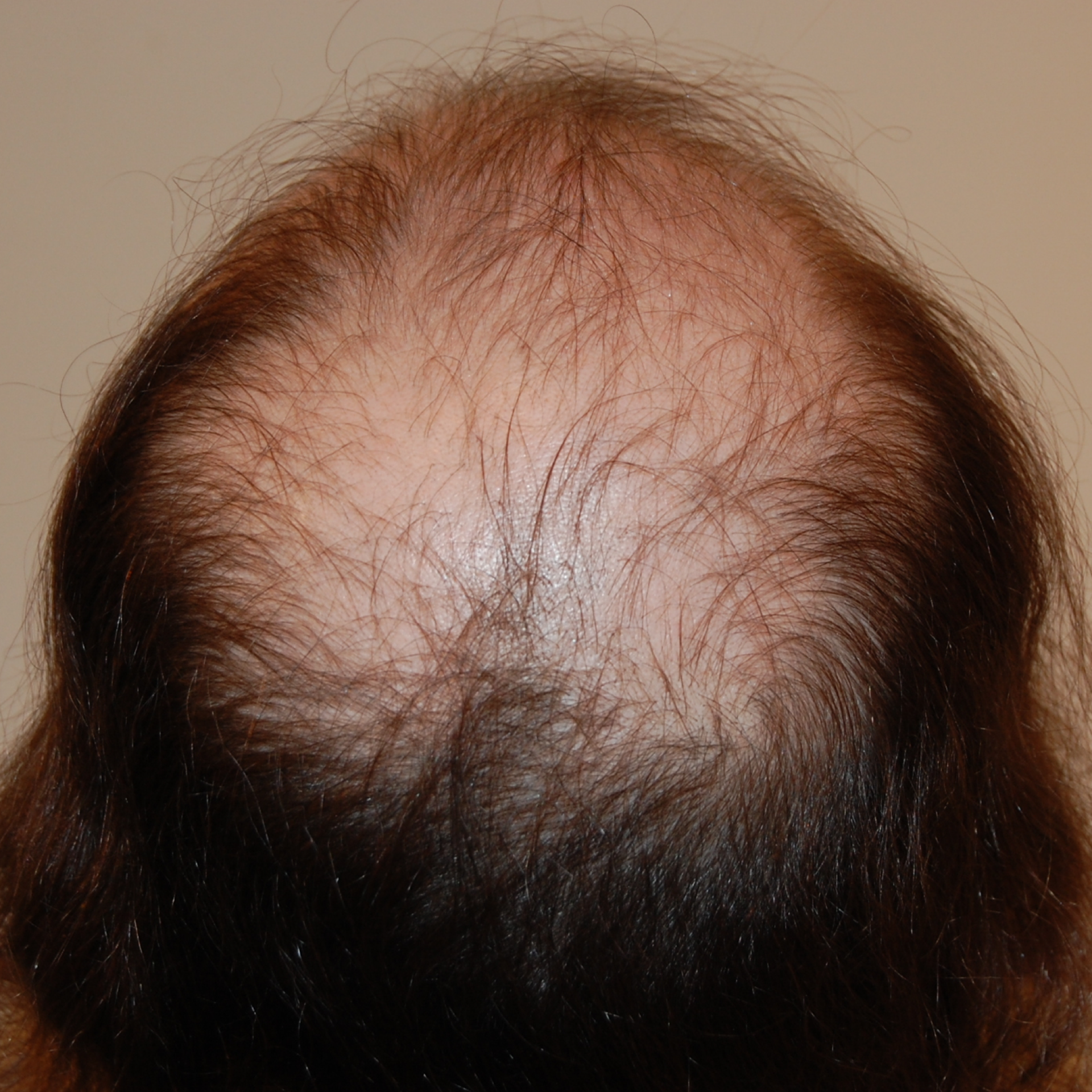 FUT Hair Transplant, Wimpole Clinic