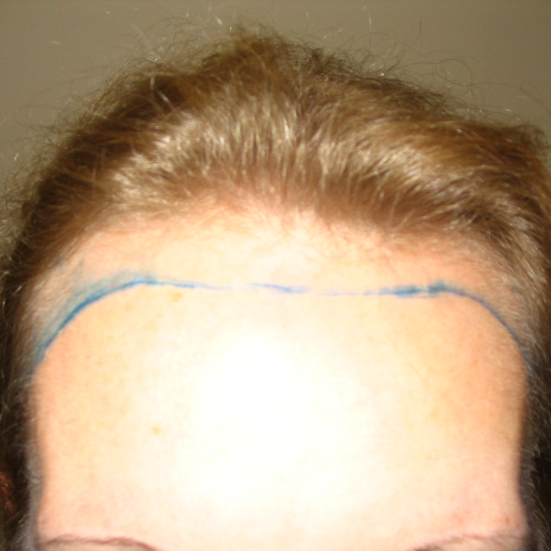 Female Hair Transplant, Wimpole Clinic