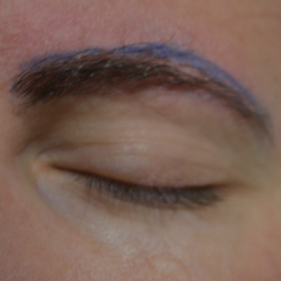 Eyebrow Transplant, Wimpole Clinic