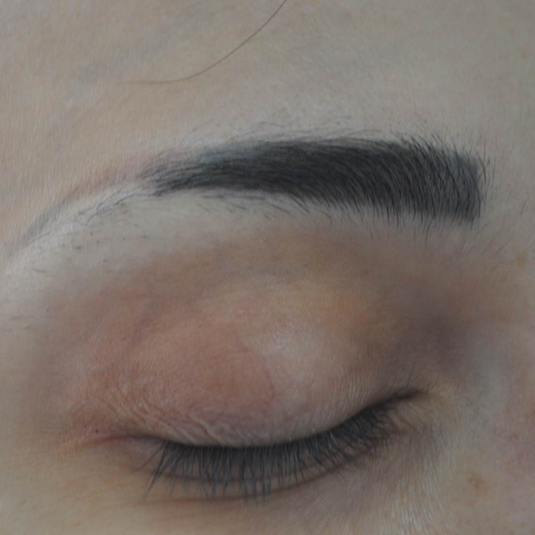 Eyebrow Transplant, Wimpole Clinic