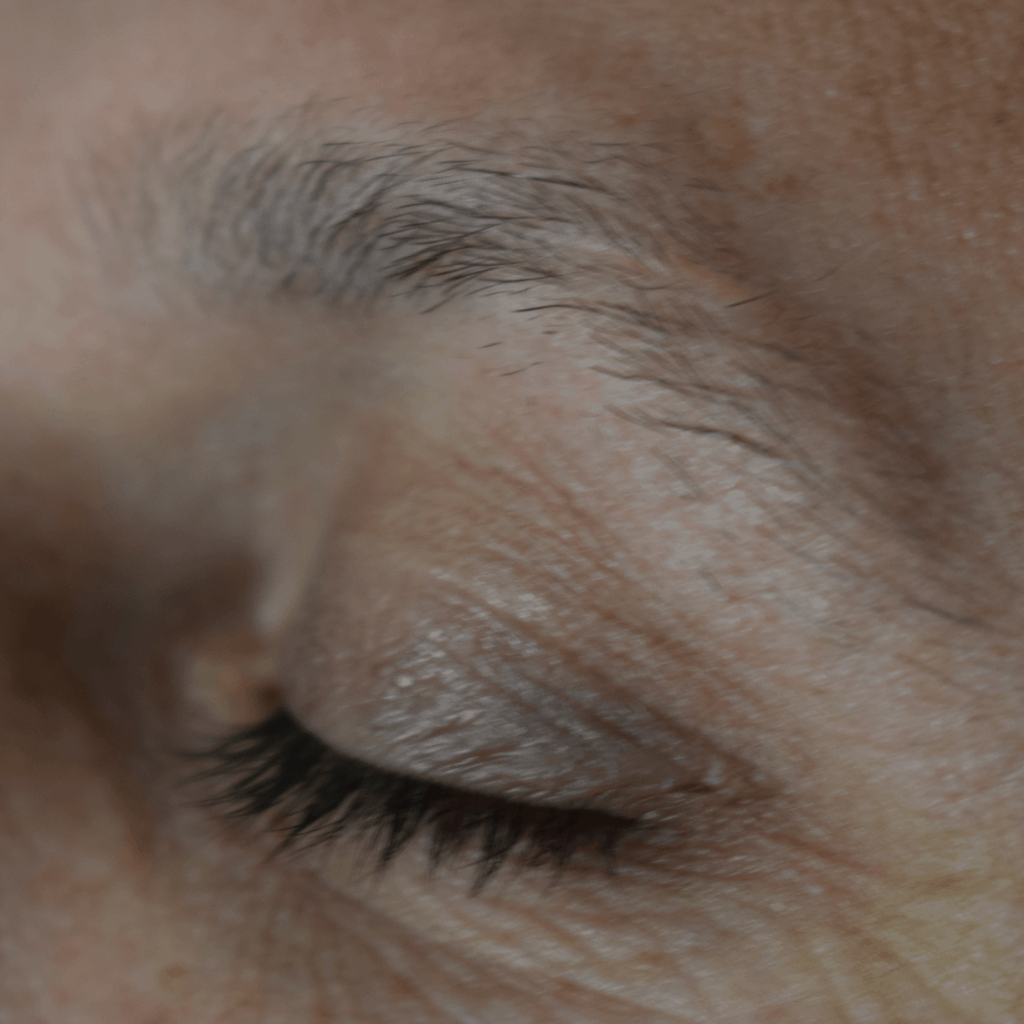 Eyebrow Transplant, Wimpole Clinic