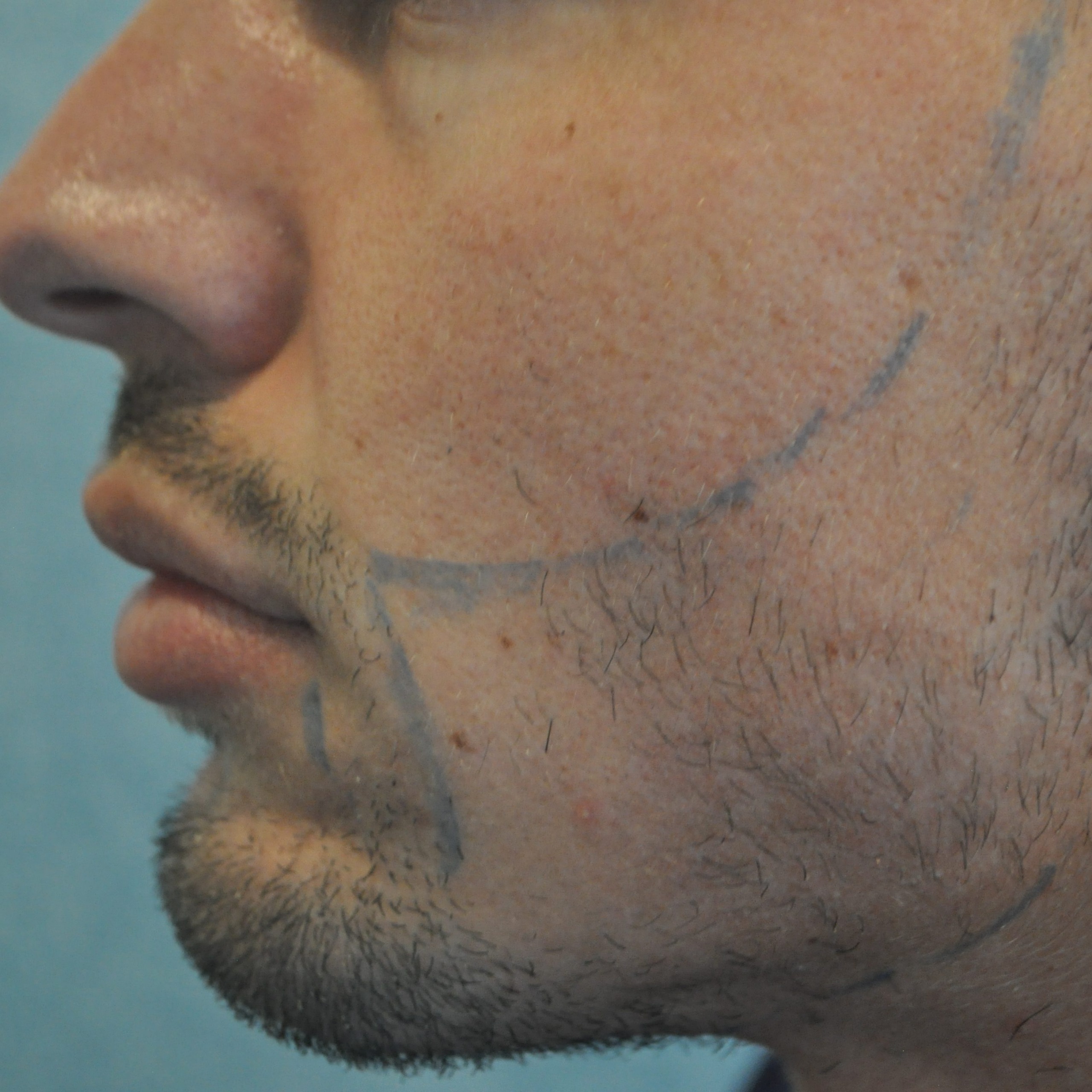 Beard Transplant, Wimpole Clinic