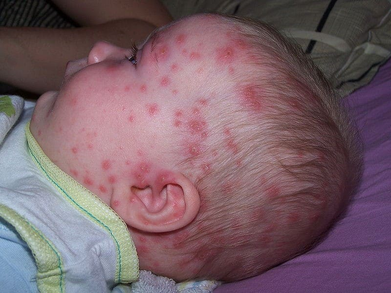 Chicken pox