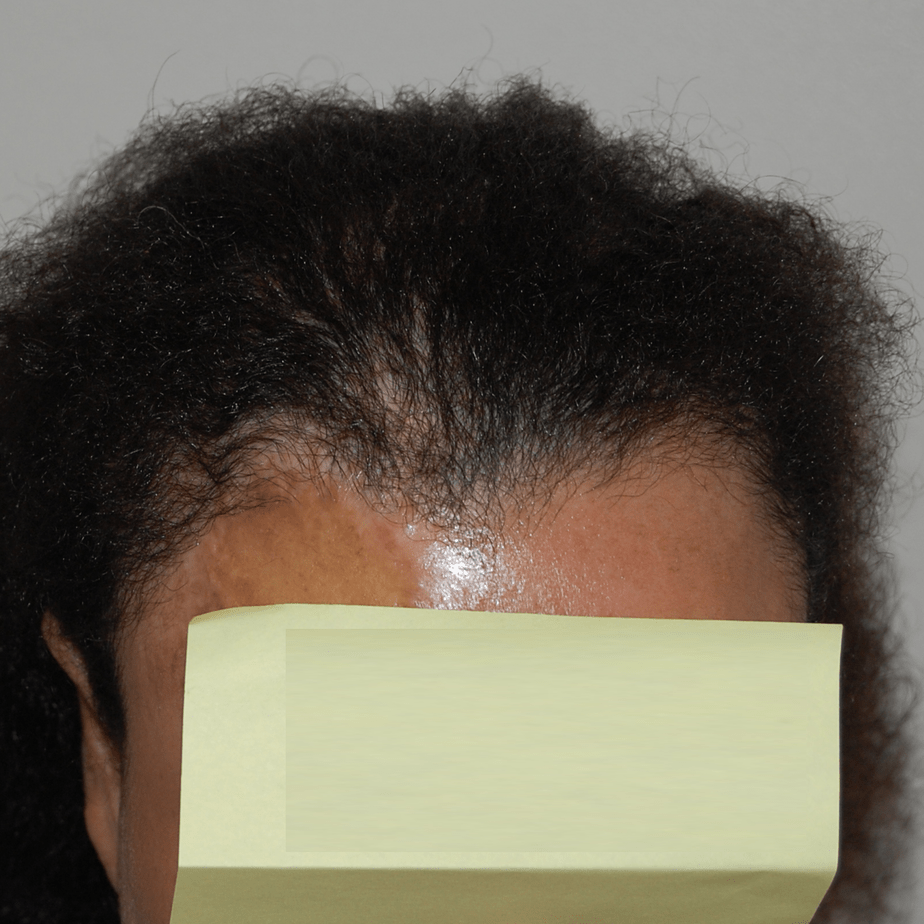 Female Hair Transplant, Wimpole Clinic