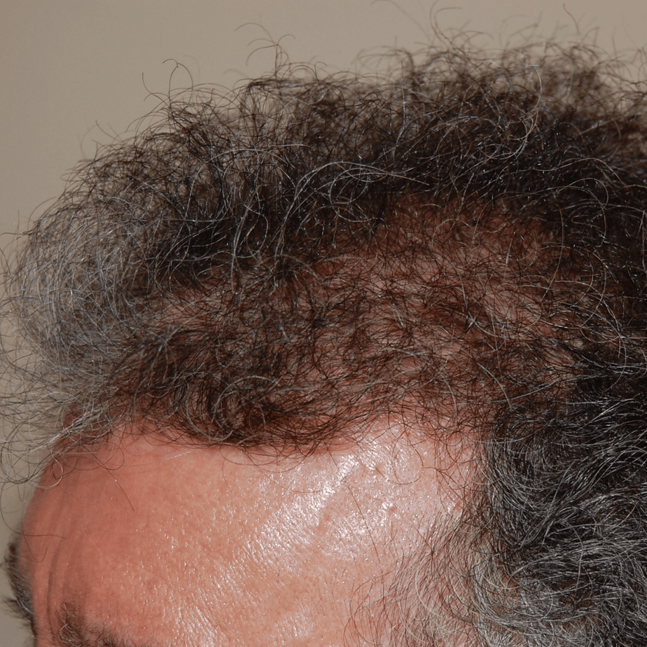 FUT Hair Transplant, Wimpole Clinic