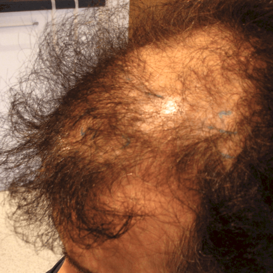 FUT Hair Transplant, Wimpole Clinic