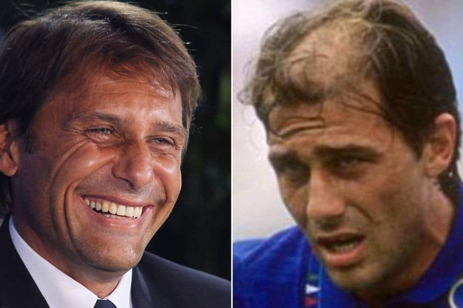 Antonio Conte Hair Transplant Featured Image