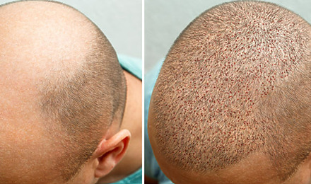 7 Days After Hair Transplant Featured Image