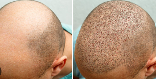 7 days after hair transplant featured image