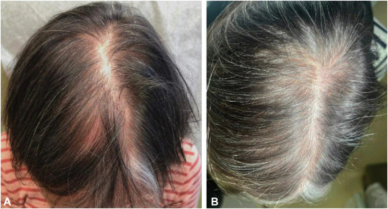 female patient before and 18 months after taking Dutasteride