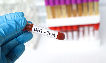 What Is DHT & Its Role In Hair Loss? A Complete Overview