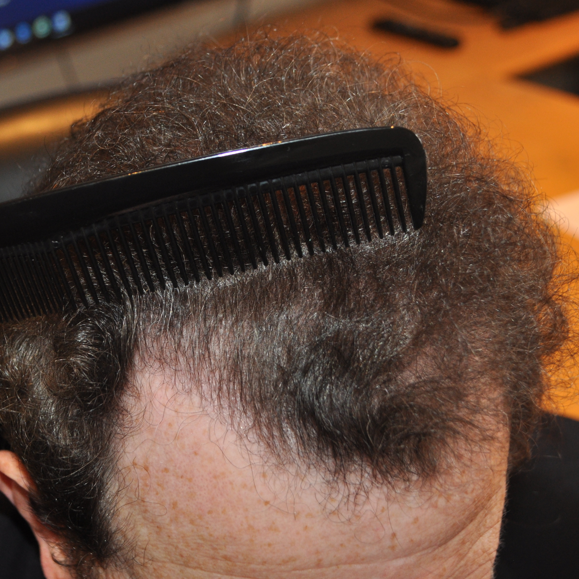 FUT Hair Transplant, Wimpole Clinic