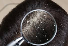 Dandruff on the scalp