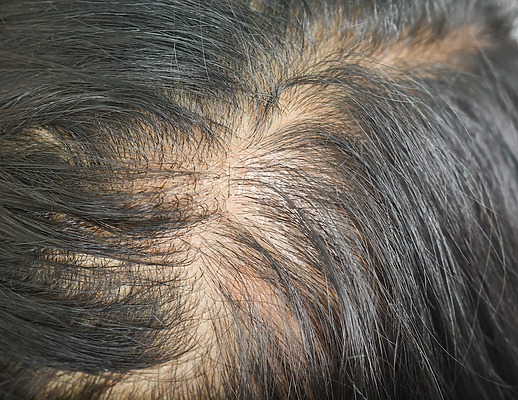 Diffuse Thinning: Signs, Symptoms, and Treatment Options